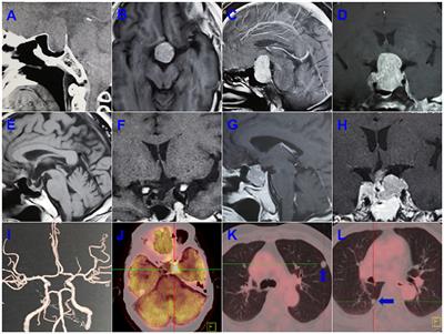 Identification of Novel Genes Involved in the Pathogenesis of an ACTH-Secreting Pituitary Carcinoma: A Case Report and Literature Review